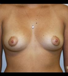 before Breast Augmentation 32