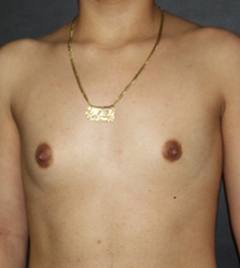 before Breast Augmentation 51