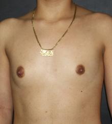 before Breast Augmentation 51