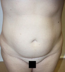 before Body Sculpting 11