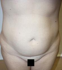 before Body Sculpting 11