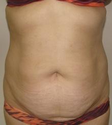 before Tummy Tuck 16