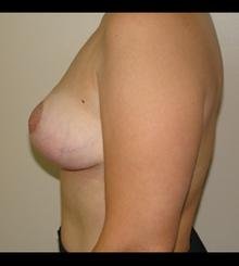 after Breast Lift 17