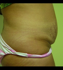 before Tummy Tuck 10