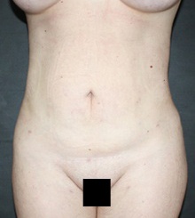 after Body Sculpting 11
