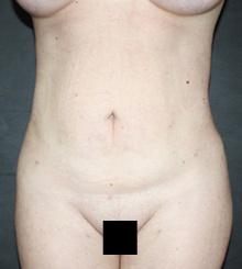 after Body Sculpting 11