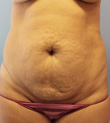 before Tummy Tuck 14