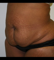 before Tummy Tuck 8