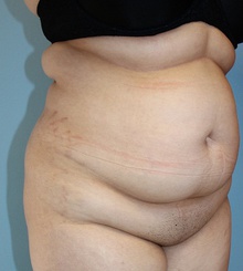 before Body Sculpting 4