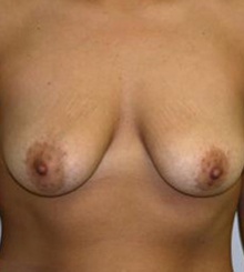 before Breast Lift 23