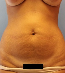 before Tummy Tuck 19
