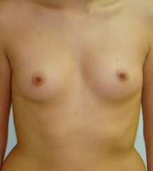 before Breast Augmentation 35