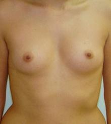 before Breast Augmentation 35