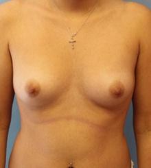 before Breast Augmentation 42