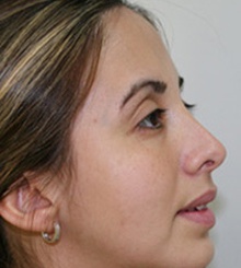 after Rhinoplasty 1