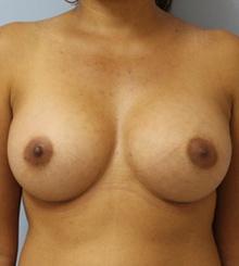 after Breast Augmentation 63