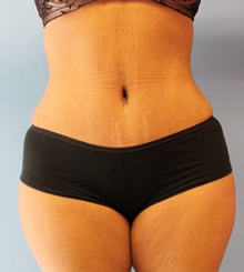 after Tummy Tuck 13
