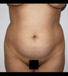 before Body Sculpting 13