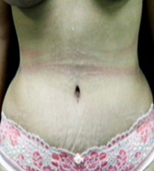 after Tummy Tuck 21