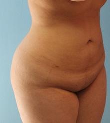 after Body Sculpting 4