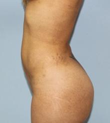 after Body Sculpting 8