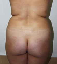 before Brazilian Butt Lift 22