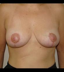 after Breast Lift 17