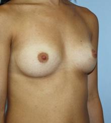 before Breast Augmentation 53
