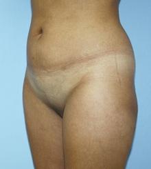 before Brazilian Butt Lift 19