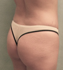 before Brazilian Butt Lift 23
