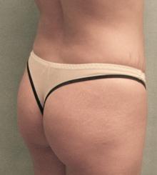 before Brazilian Butt Lift 23