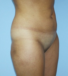 before Body Sculpting 9