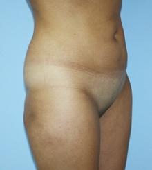 before Body Sculpting 9