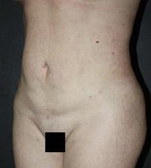 after Body Sculpting 11