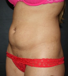 before Body Sculpting 7