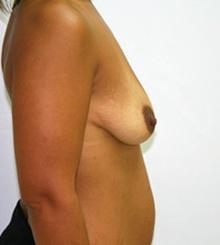 before Breast Lift 21