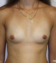 before Breast Augmentation 10