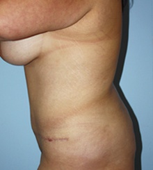 after Tummy Tuck 18