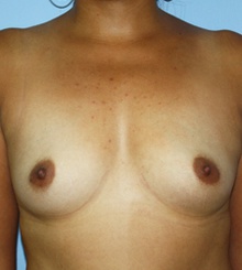 before Breast Augmentation 63