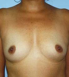 before Breast Augmentation 63