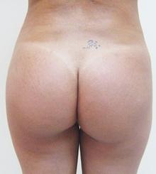 after Brazilian Butt Lift 23