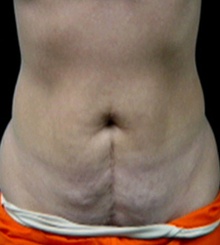 before Tummy Tuck 20