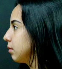 before Rhinoplasty 2