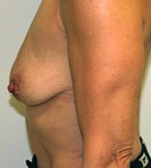 before Breast Lift 13
