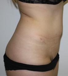 before Brazilian Butt Lift 30