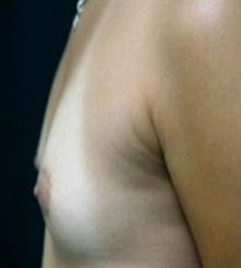 before Breast Augmentation 19
