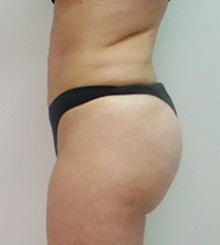 after Brazilian Butt Lift 14