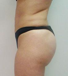 after Brazilian Butt Lift 14