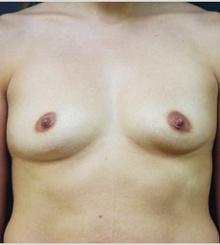 before Breast Augmentation 20