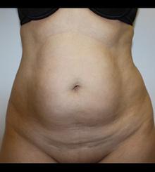 before Body Sculpting 14